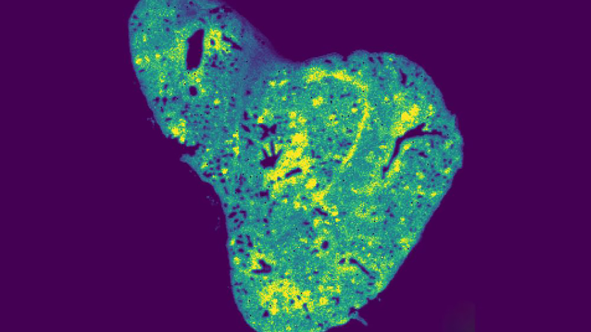 Breast cancer metastasis